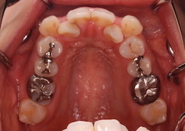 小臼歯抜歯にて治療を行った叢生症例