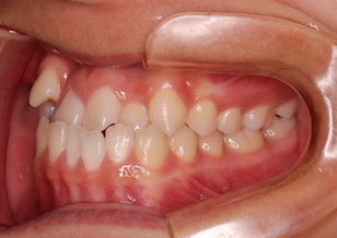 非抜歯にて治療を行った叢生をともなう反対咬合症例