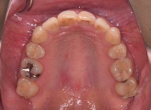 外傷による前歯部の歯根吸収を認め、骨癒着が疑われた叢生(ガタガタの歯並び)をともなう上顎前突症例。
