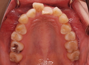 外傷による前歯部の歯根吸収を認め、骨癒着が疑われた叢生(ガタガタの歯並び)をともなう上顎前突症例。