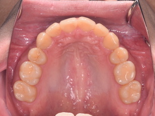 上下顎歯列に叢生をともなう上顎前突症例