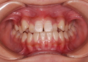 非抜歯にて治療を行った叢生(ガタガタの歯並び)症例
