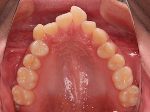 上下顎歯列に叢生をともなう上顎前突症例