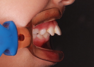 先天欠如歯をともなう成長期の上顎前突症例。