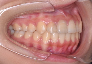 小臼歯非抜歯にて治療を行った叢生(ガタガタの歯並び)症例。