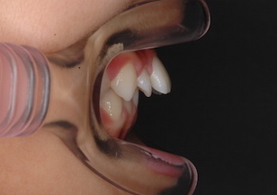 小臼歯抜歯にて治療を行った上顎前突症例。