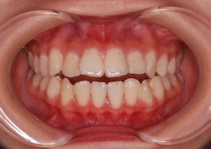 上下顎前歯のリトラクションを行って治療した開咬症例。