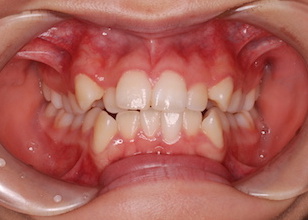 小臼歯非抜歯にて治療を行った叢生(ガタガタの歯並び)症例。