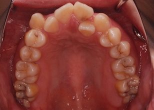 上下顎歯列に重度の叢生を認める上下顎前突症例。