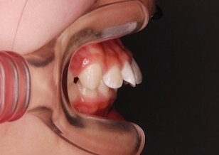 ヘッドギアによる上顎骨の成長コントロール治療で治癒した上顎前突症例。