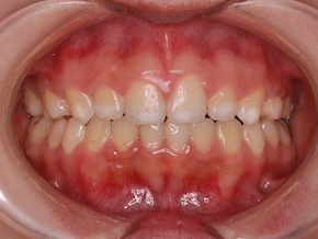 先天欠如歯4歯と埋伏歯１歯を認める開咬症例。