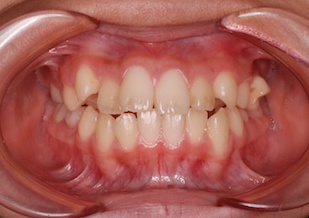上下顎歯列に叢生を認める上下顎前突症例。