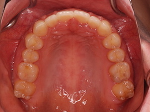 先天欠如歯をともなう上下顎歯列のスペースアーチ(隙っ歯)症例