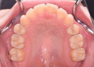 上下顎歯列に重度の叢生を認める上下顎前突症例。