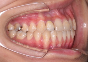 非抜歯にて治療を行った成人の重篤な開咬症例。