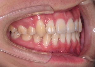 上下顎歯列に重度の叢生を認める症例。