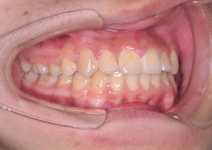 ペンデュラムアプライアンスにて大臼歯後方移動を行って、非抜歯にて矯正治療を行った叢生症例。