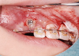 上顎埋伏犬歯(2本)の開窓・牽引症例。