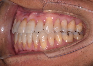 叢生(ガタガタの歯並び)をともなう前歯部反対咬合症例。