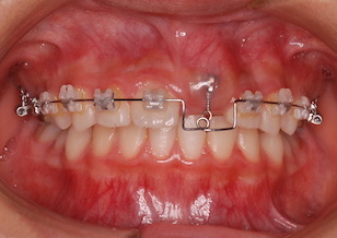 埋伏歯（上顎中切歯）の開窓・牽引治療例。