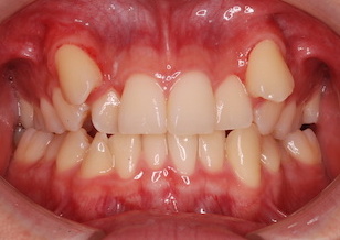 上顎小臼歯抜歯にて治療を行なった叢生症例。