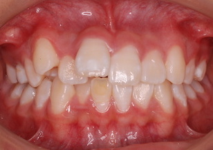 上顎前歯部に埋伏過剰歯を認めた叢生症例。