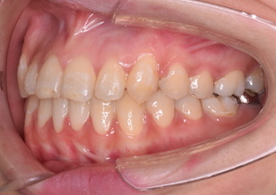 左右側方歯部の開咬症例。