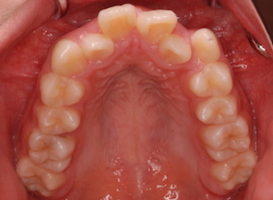 小臼歯便宜抜歯にて治療を行なった叢生症例。