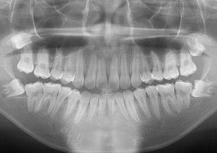 下顎右側埋伏犬歯の開窓・牽引治療例。