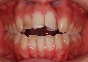 先天欠如歯をともなった開咬症例。