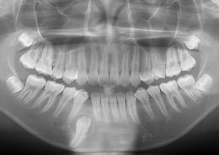 下顎右側埋伏犬歯の開窓・牽引治療例。