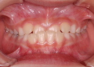 成長発育期の上顎歯列に叢生をともなう反対咬合。