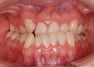 〜外科的矯正治療〜　叢生をともなう下顎前突症。