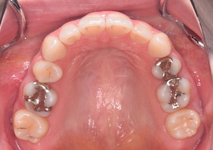 左右大臼歯部に交叉咬合を認める上下顎前突症例。