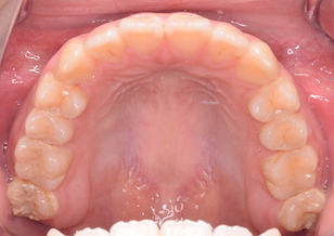 小臼歯非抜歯にて矯正治療を行なった叢生症例。