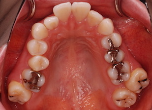 左右大臼歯部に交叉咬合を認める上下顎前突症例。