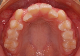 小臼歯非抜歯にて矯正治療を行なった叢生症例。