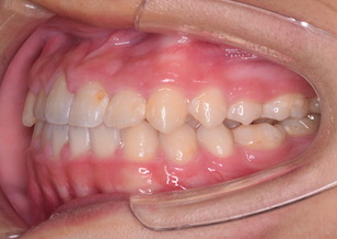 上顎前歯部に叢生(ガタガタの歯並び)をともなう反対咬合症例。