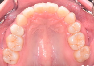 上下顎歯列に叢生をともなう上下顎前突症例。