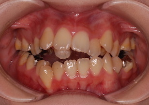 上下顎歯列に叢生をともなう開咬症例。