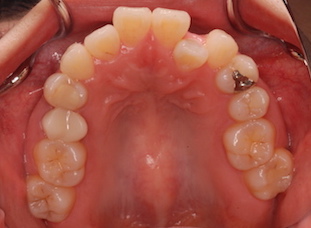 上下顎歯列に叢生をともなう上下顎前突症例。
