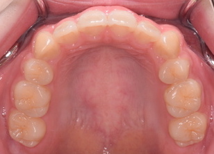 小臼歯抜歯にて治療を行なった叢生(ガタガタの歯並び)症例。