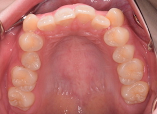 小臼歯抜歯にて治療を行なった叢生(ガタガタの歯並び)症例。