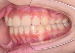 混合歯列期より矯正治療を開始した叢生症例。