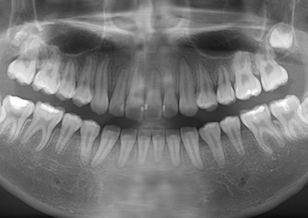 埋伏上顎第2小臼歯の開窓・牽引治療例。