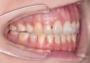 上下顎歯列に叢生を認める重度の開咬症例。