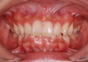 右側大臼歯部に交叉咬合（すれ違い咬合）を有する過蓋咬合症例