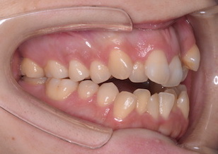 上下顎歯列に叢生を認める重度の開咬症例。