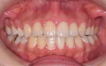 叢生をともなう上顎前突・前歯部開咬症例。
