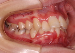 リンガルブラケットを用いて治療を行った上下顎前歯部に叢生をともなう上顎前突症例。